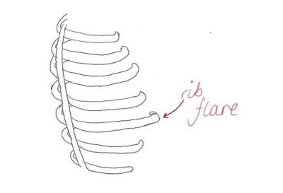 Ribcage diagram with rib flare